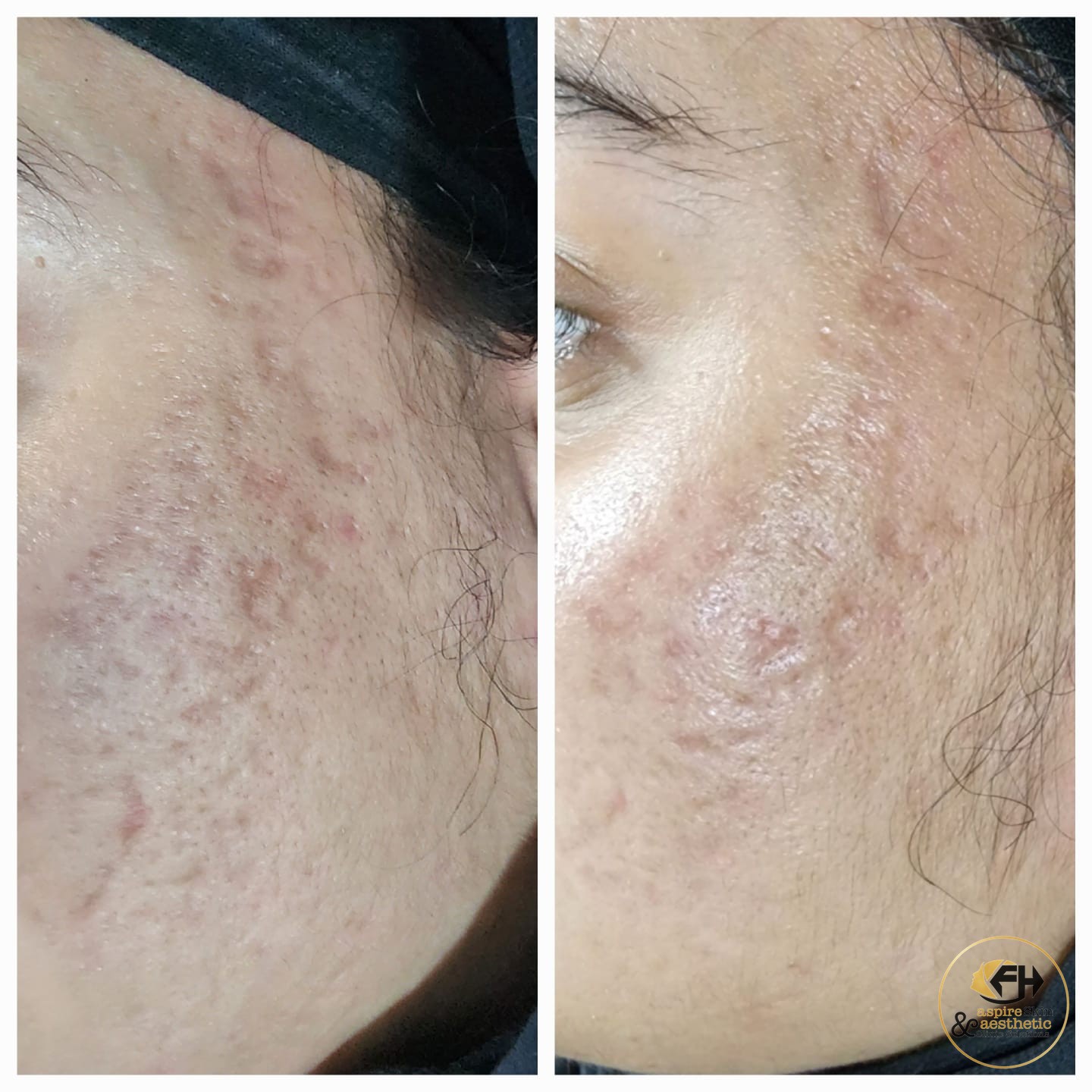 Acne scar treatment before and after result, cheek area