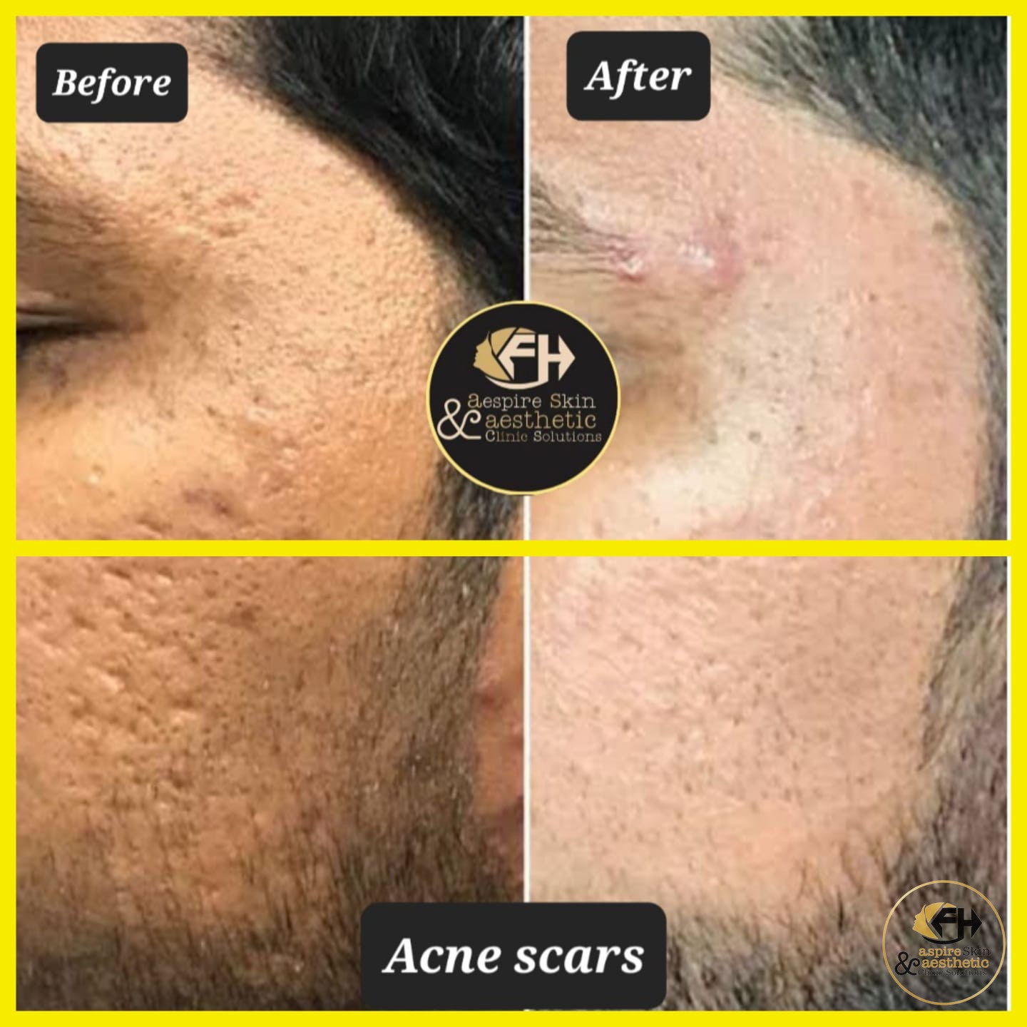 Acne scar treatment before and after result by Dr. Fawad Hussain