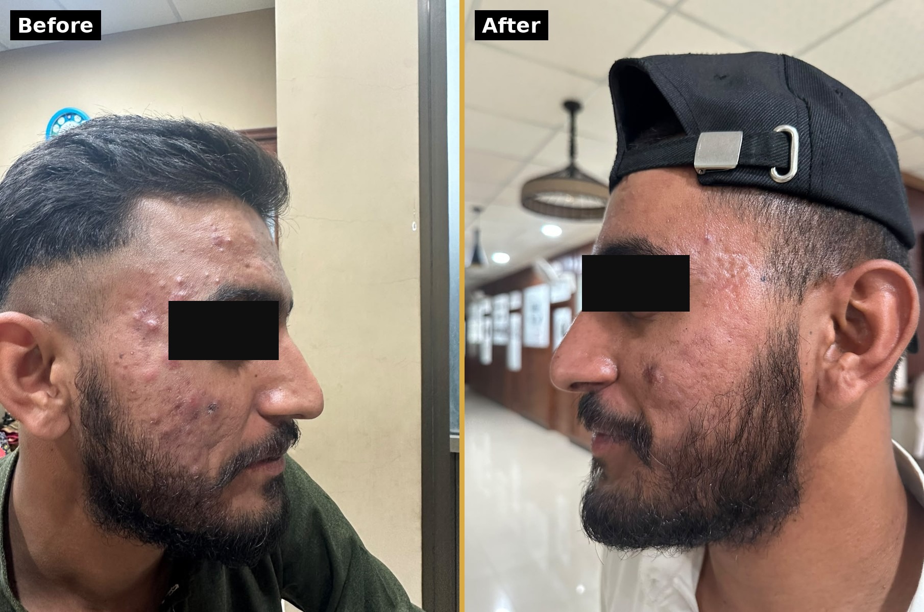 Acne treatment before and after result by Dr. Fawad Hussain