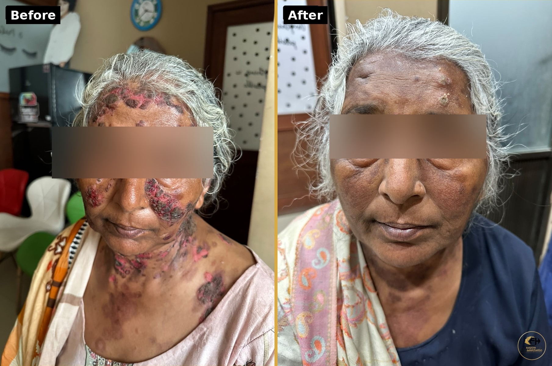 Bullous pemphigoid treatment before and after result by Dr. Fawad Hussain