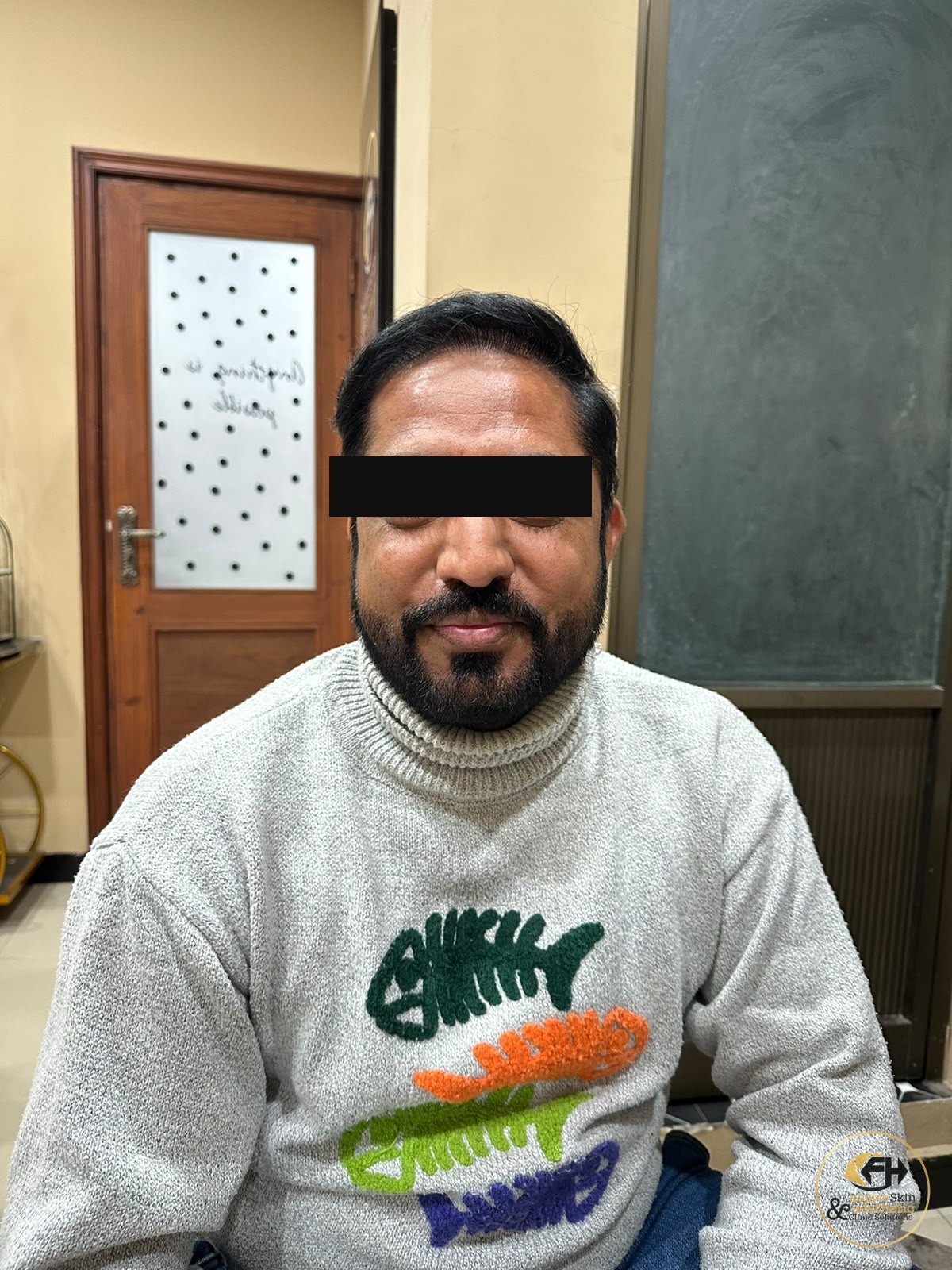 Hair transplant result by Dr. Fawad Hussain