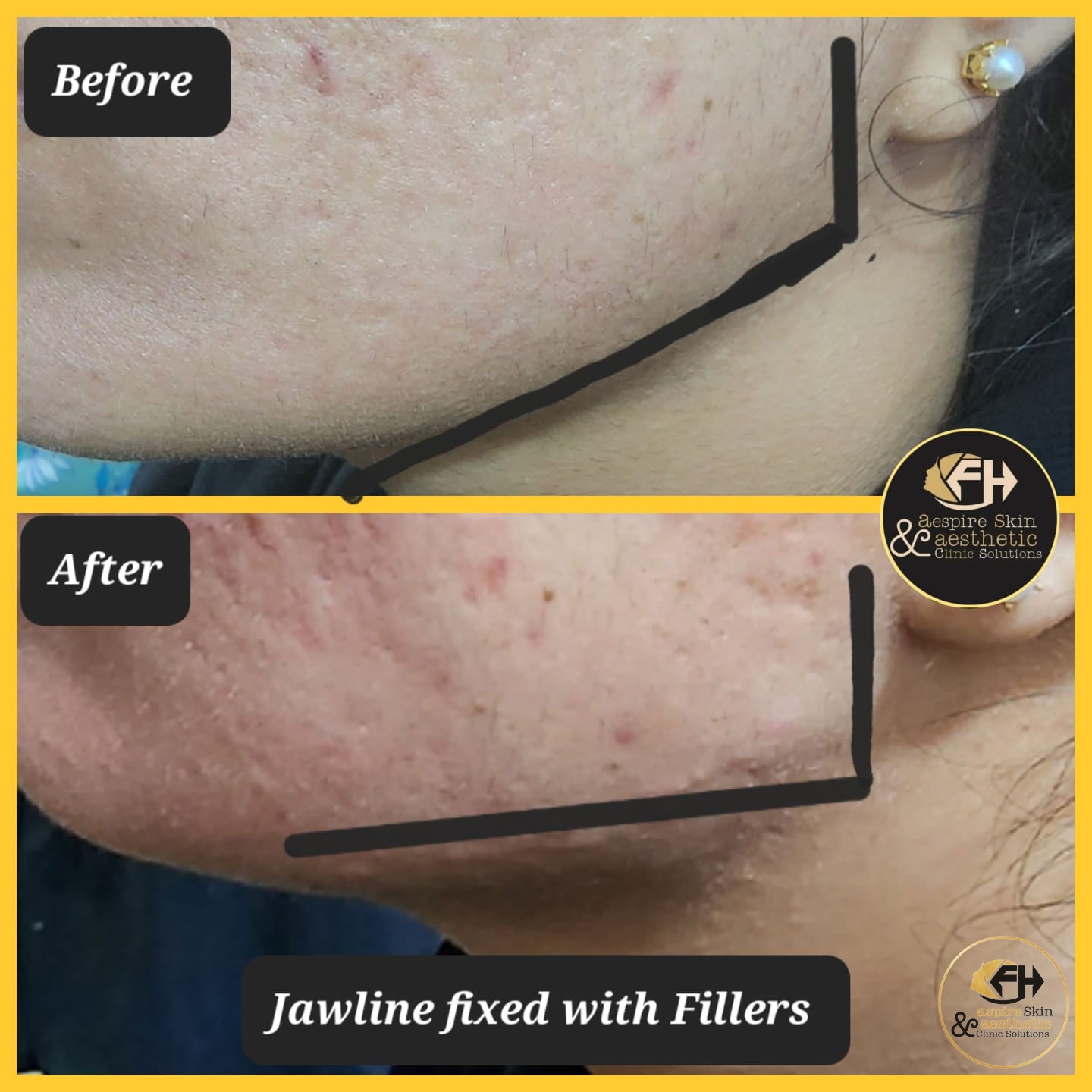 Jawline contouring filler before and after result