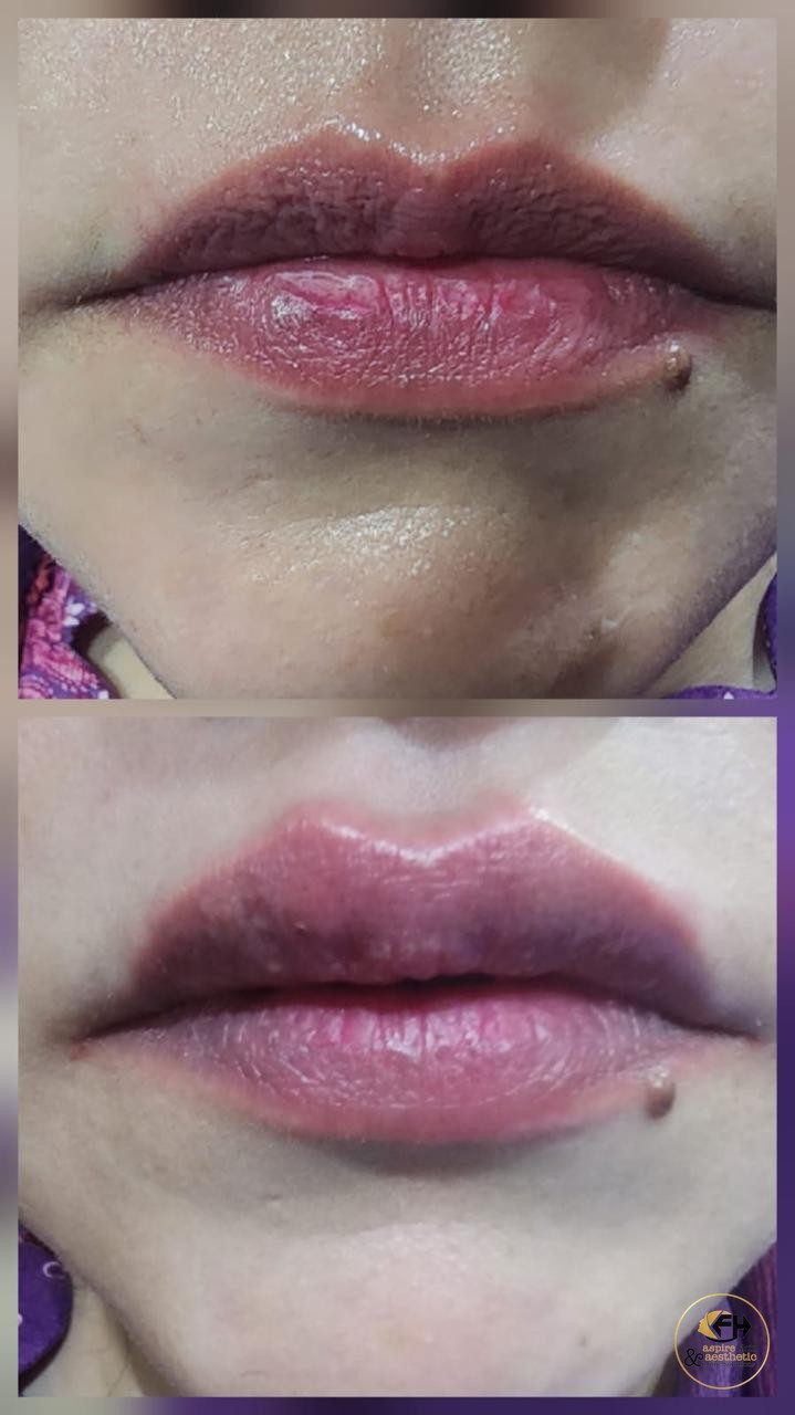 Lip enhancement before and after result