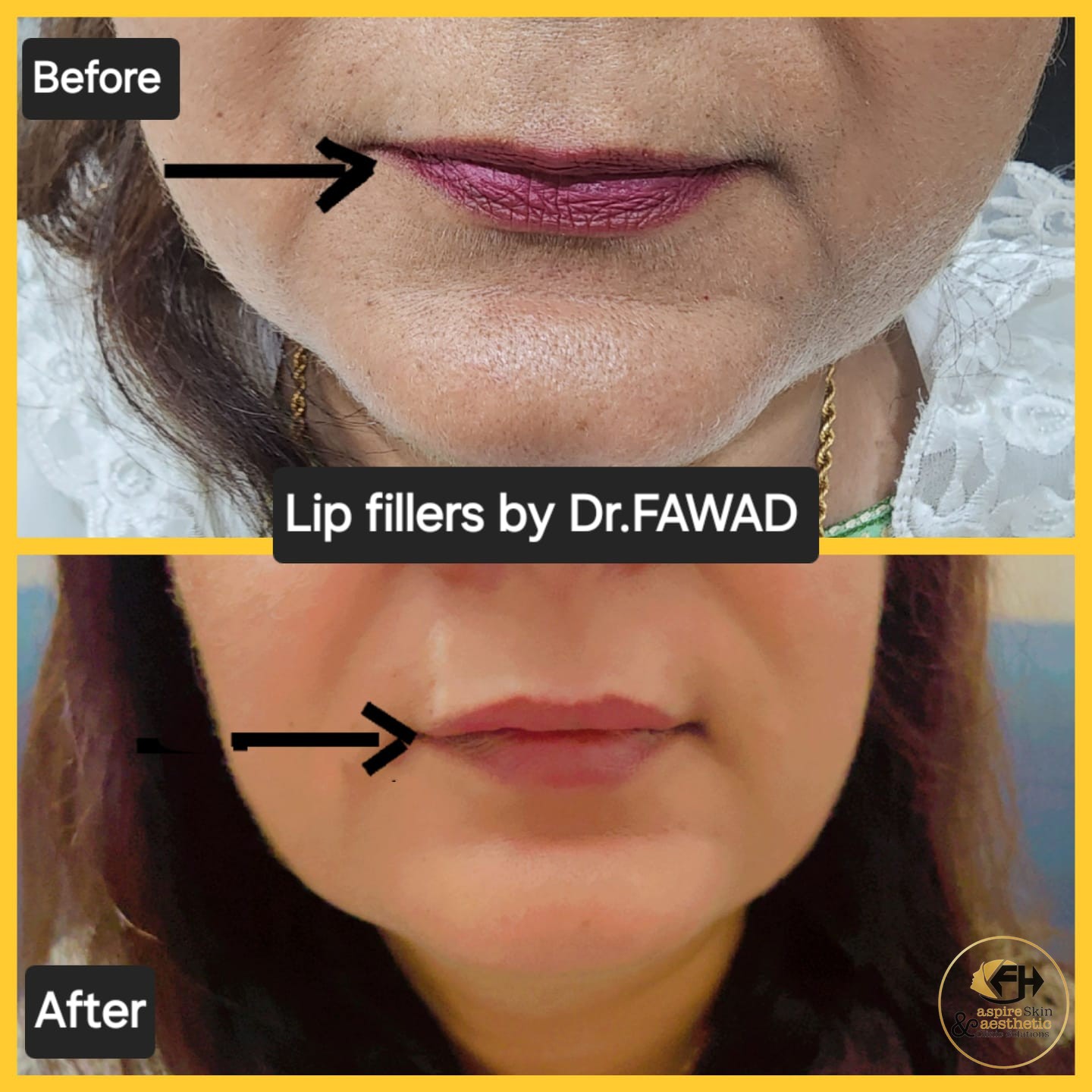 Lip filler before and after result by Dr. Fawad Hussain