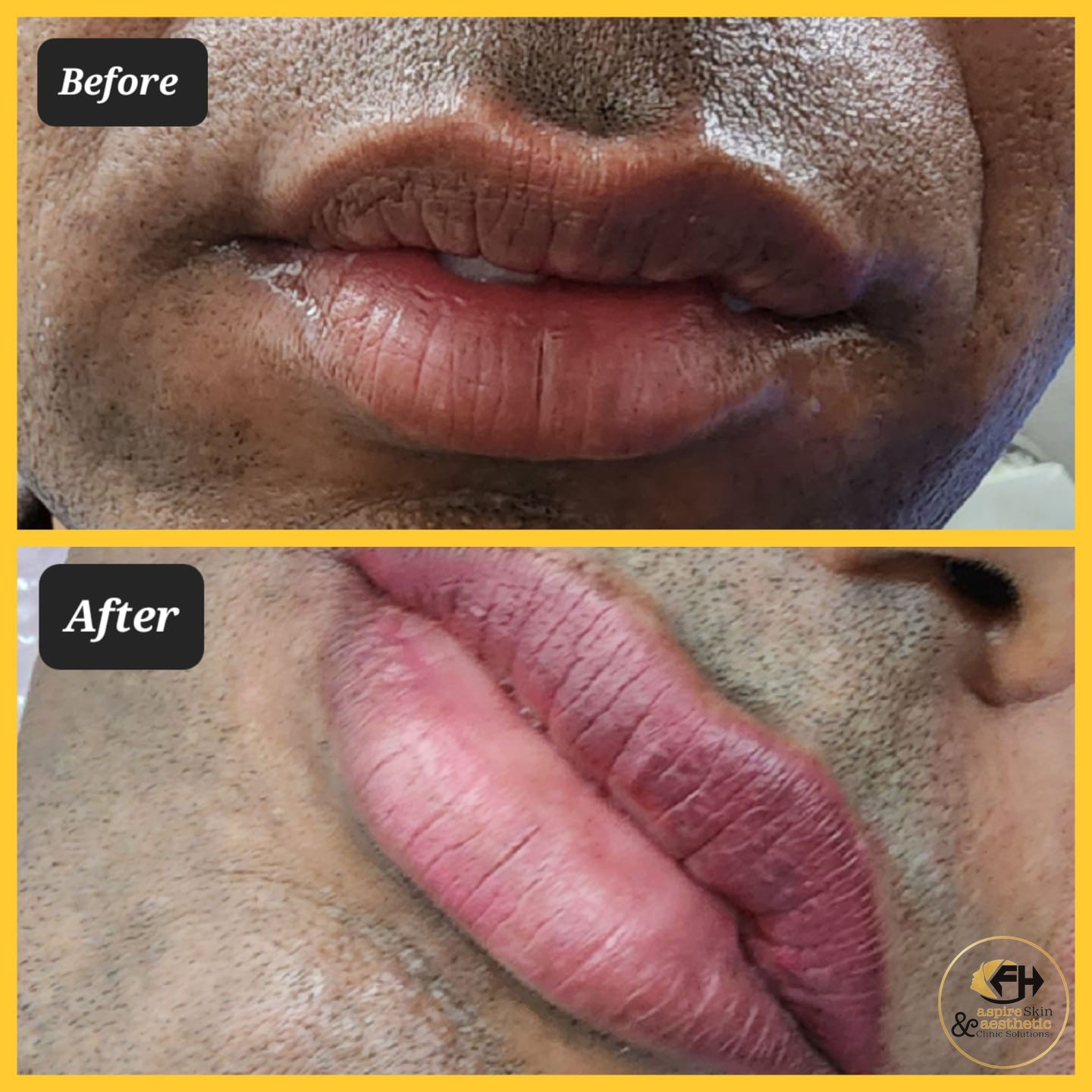 Lip tint treatment before and after result