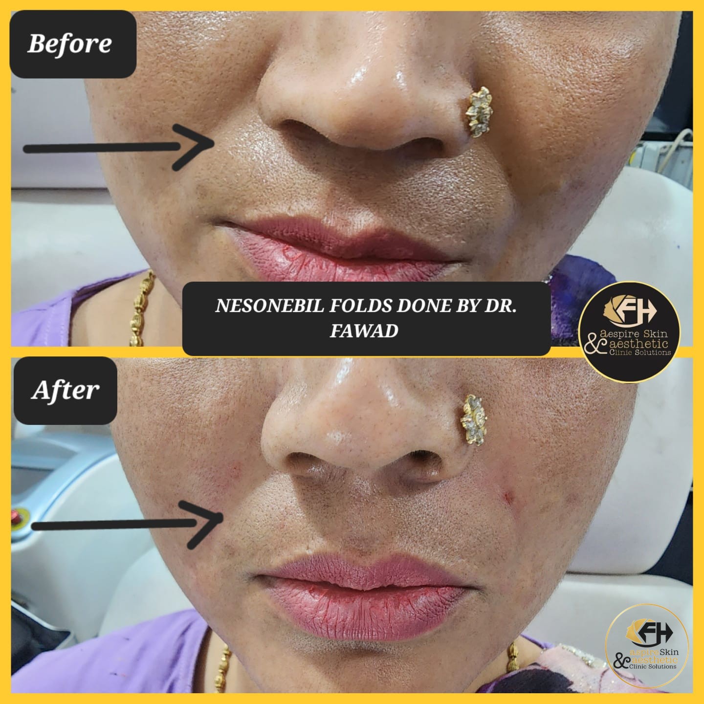 Nasolabial fold filler before and after result, side view