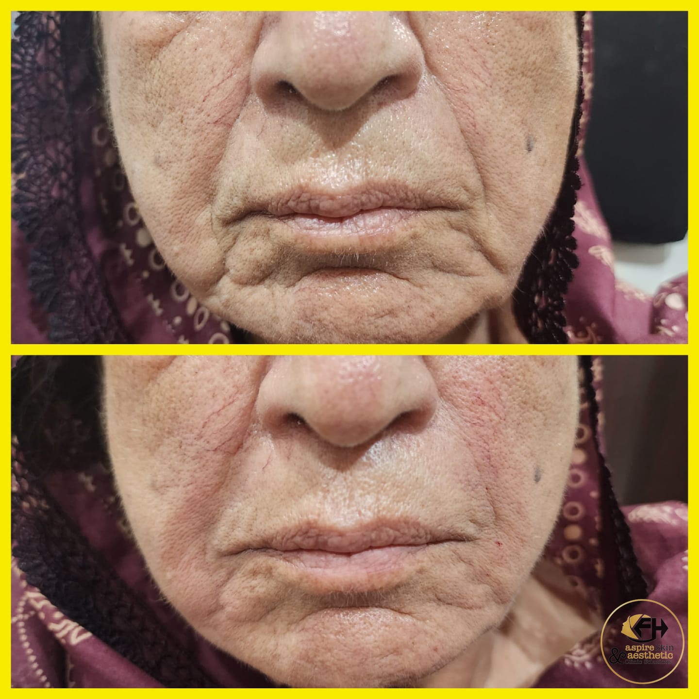 Nasolabial fold filler before and after result, close-up