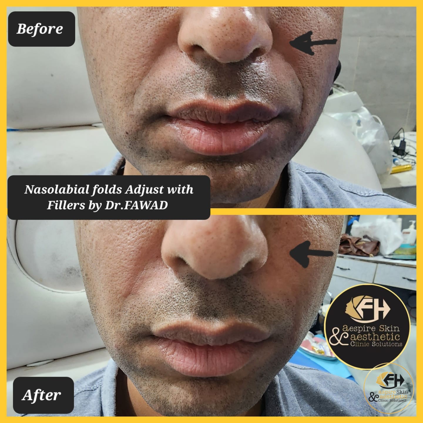 Nasolabial fold filler before and after result