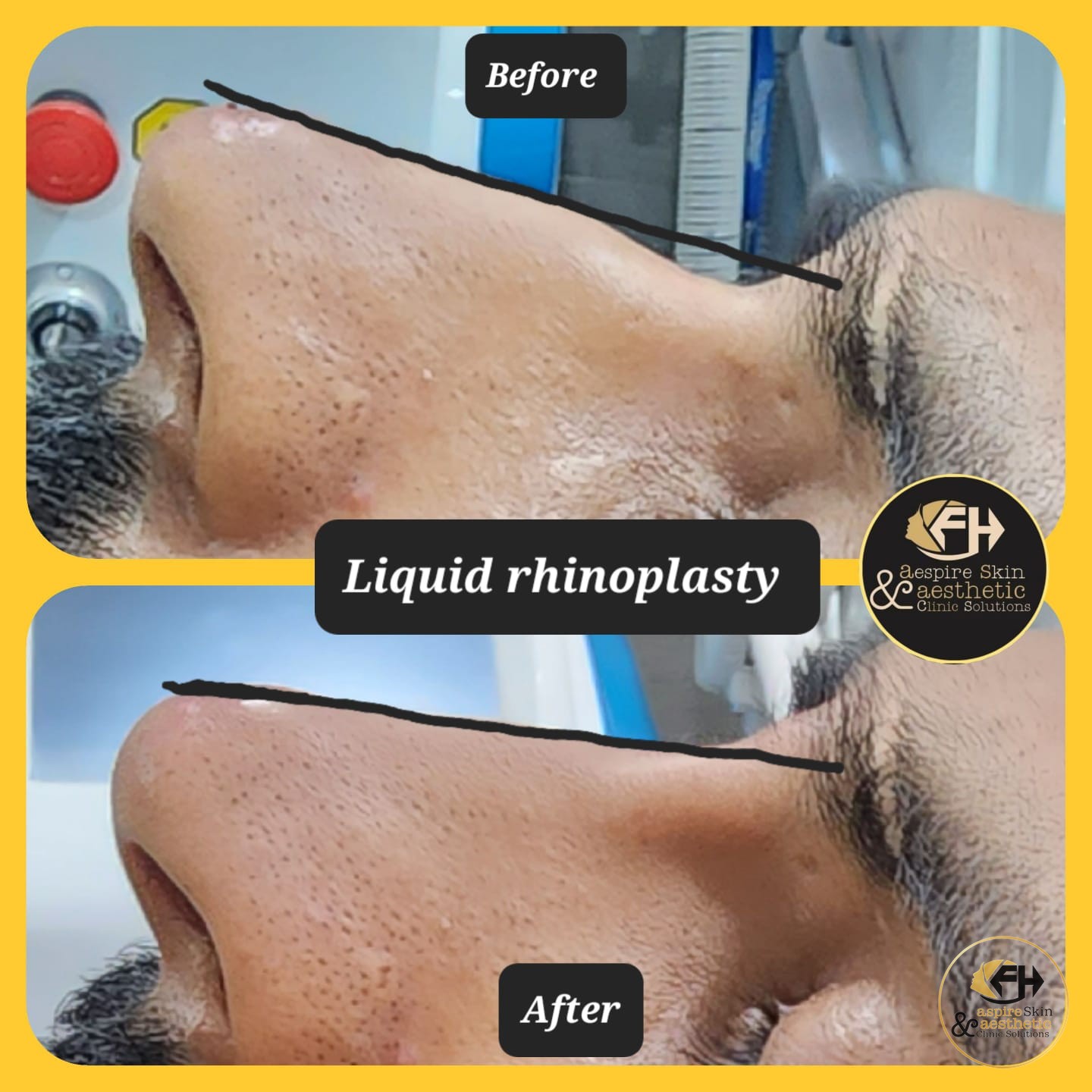Liquid rhinoplasty nose reshaping before and after result