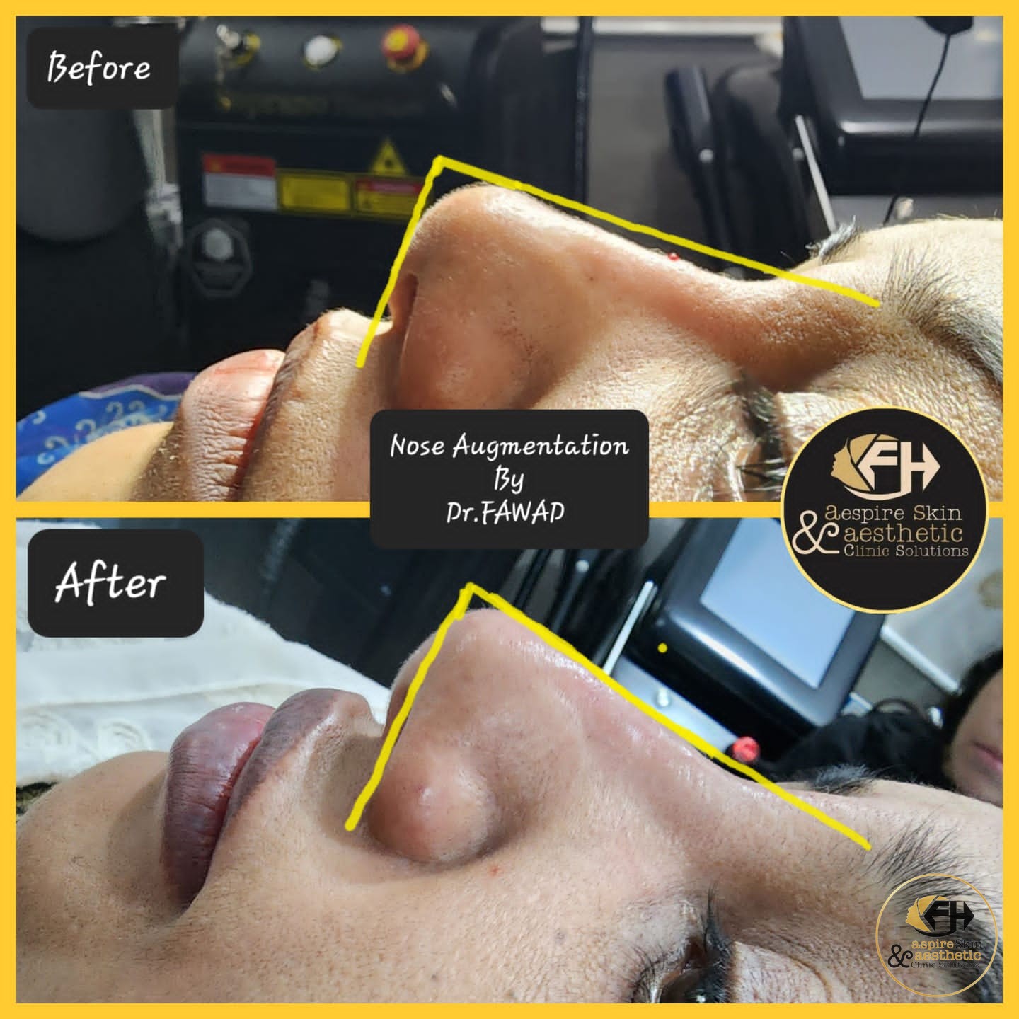Nose augmentation before and after result, side profile