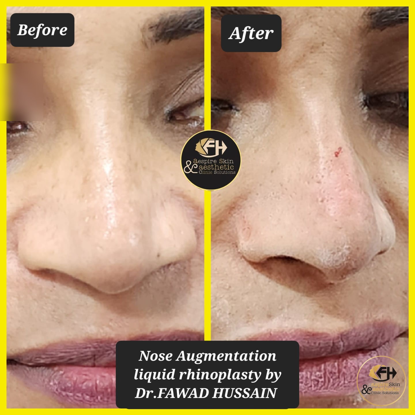 Nose augmentation liquid rhinoplasty before and after result