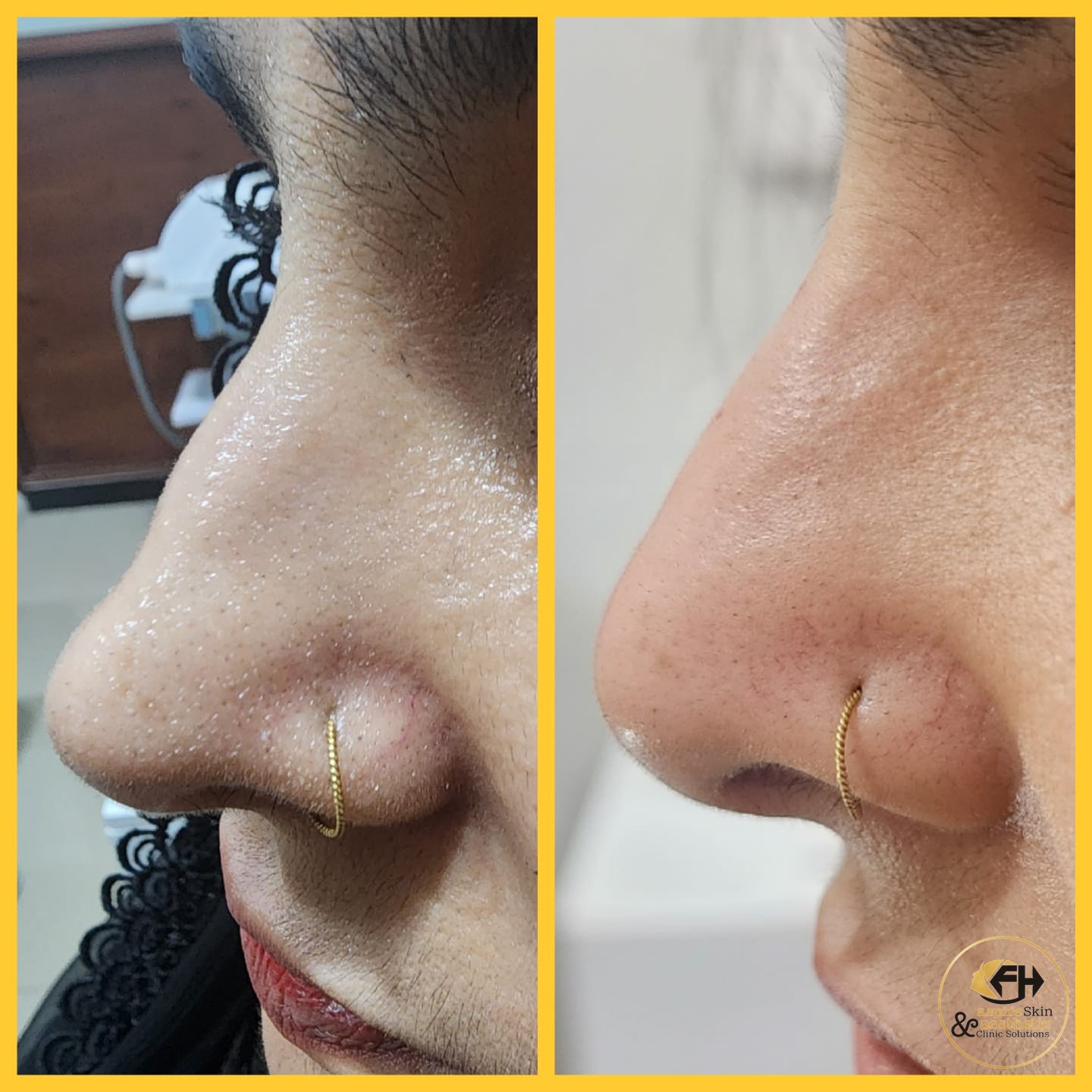 Nose reshaping before and after result, side profile