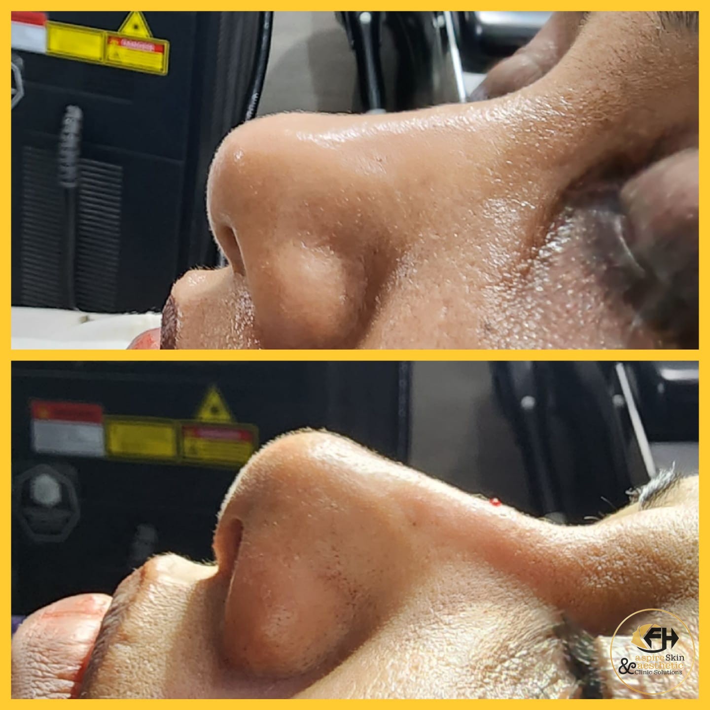 Nose reshaping before and after result, macro close-up