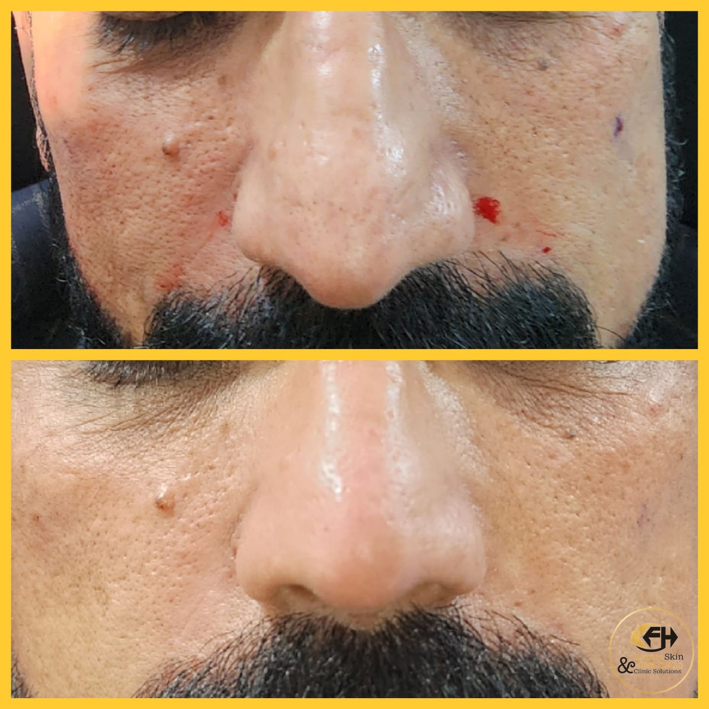 Nose filler reshaping before and after result, frontal view