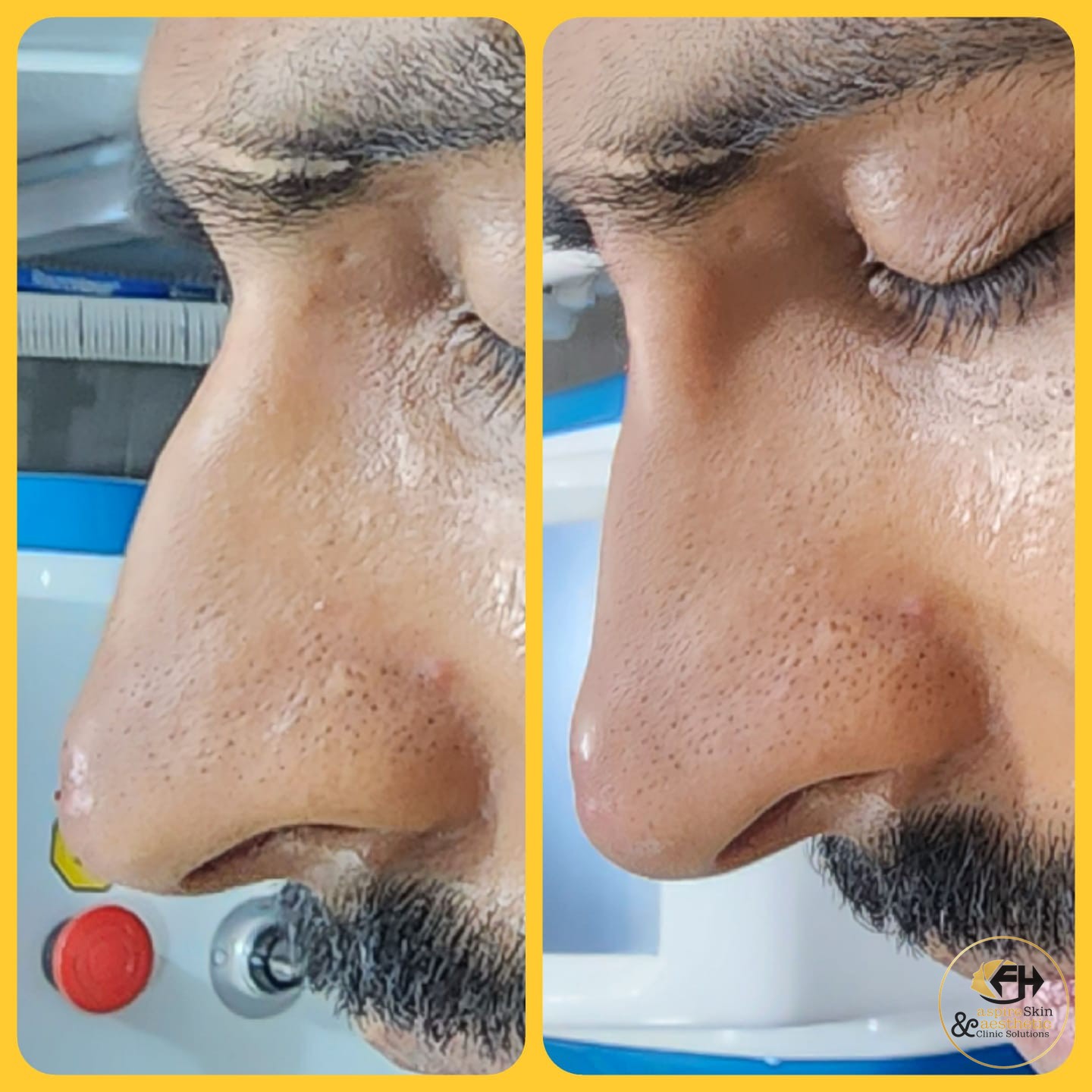 Nose tip refinement before and after result