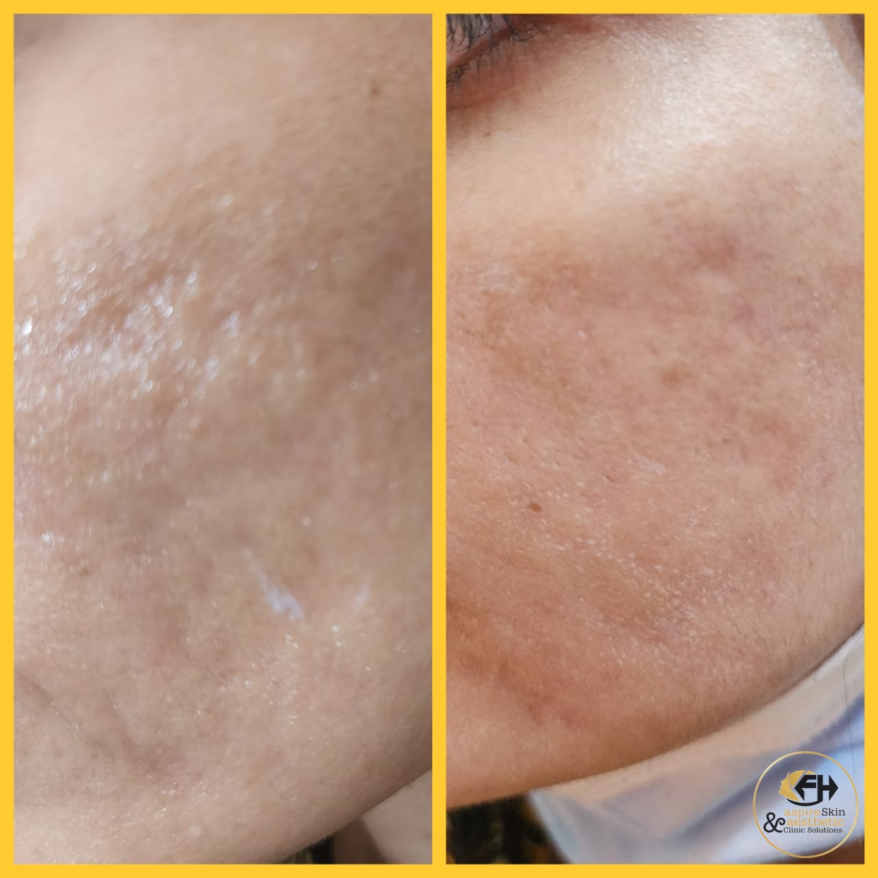 Skin pigmentation treatment before and after result, cheek area