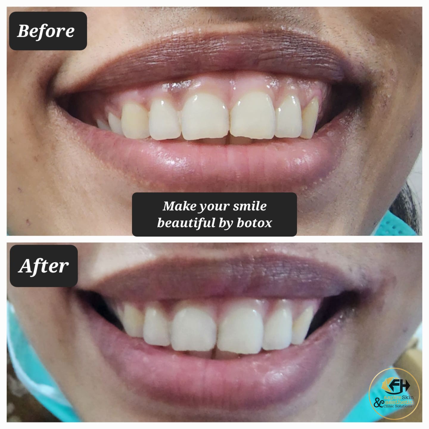Smile enhancement botox before and after result