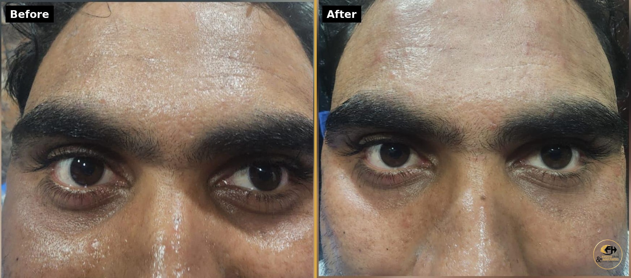 Under eye filler treatment before and after result, frontal view