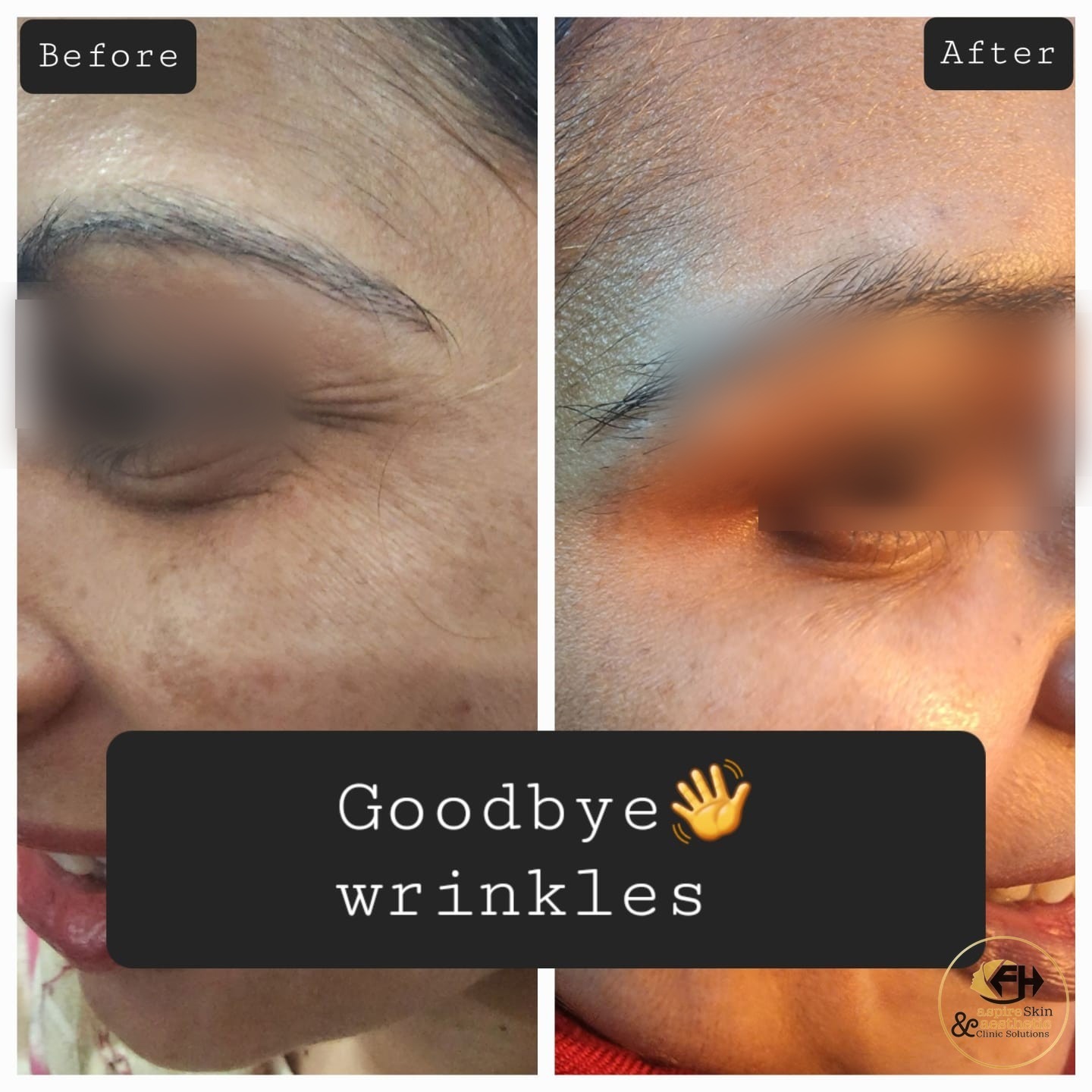 Anti wrinkle treatment before and after result